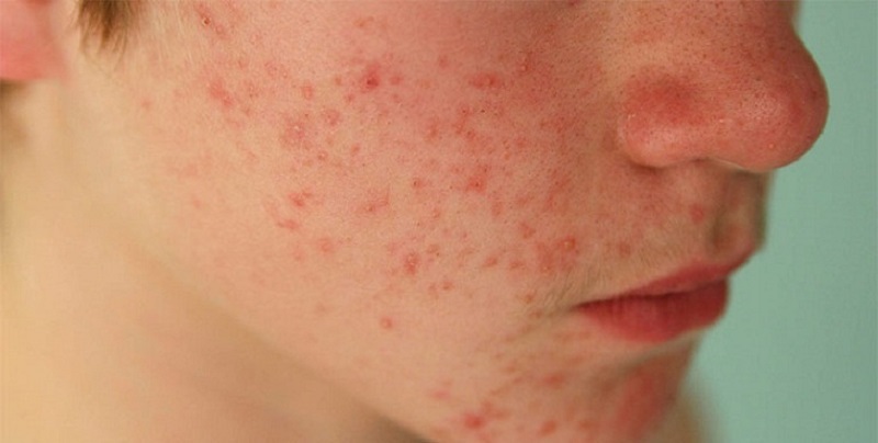 Da mặt bị nổi mẩn đỏ không ngứa do nhiễm siêu vi