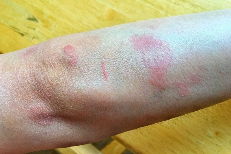 Lupus ban đỏ có thể gây nổi mẩn đỏ ở tay chân, mặt