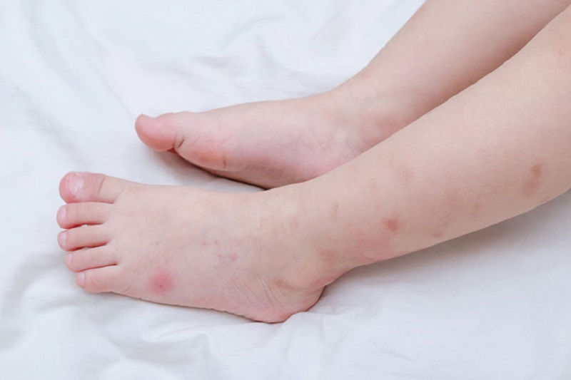 Nổi mẩn đỏ ngứa như muỗi đốt có thể là dấu hiệu cảnh lý nhiều căn bệnh tiềm ẩn