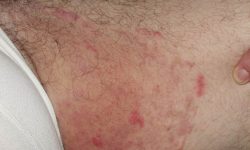 Nổi mẩn đỏ ở háng không ngứa có thể là do viêm da tiếp xúc