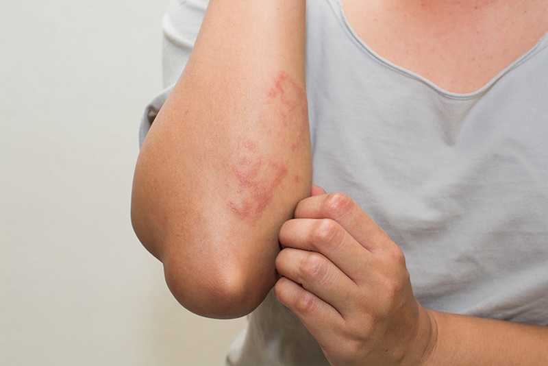 Nổi mẩn đỏ ở tay có thể do bị mề đay mẩn ngứa