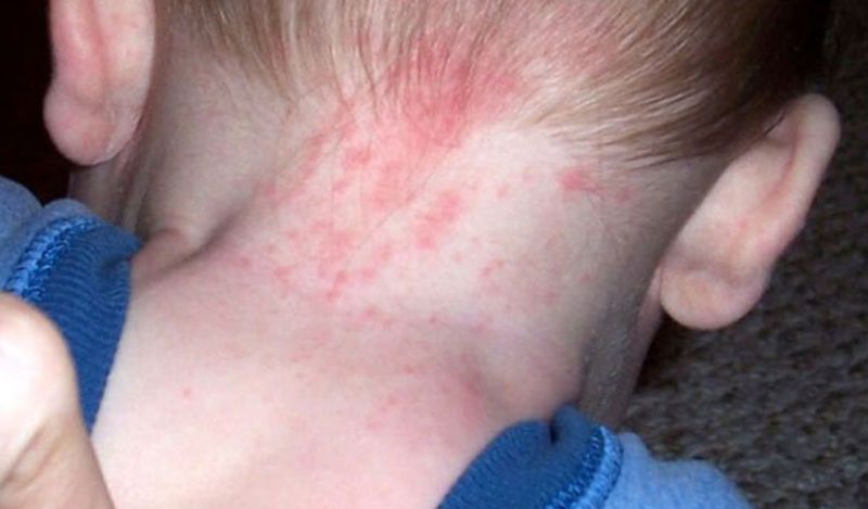 Nổi mẩn đỏ trên đầu trẻ có thể là do ban đỏ