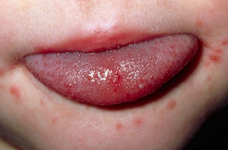 Trẻ bị nổi mẩn đỏ xung quanh miệng có thể do bị nấm