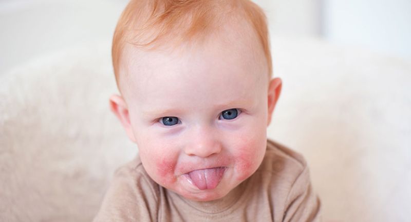 Trẻ bị nổi xung quanh miệng cũng có thể là triệu chứng của bệnh lở miệng