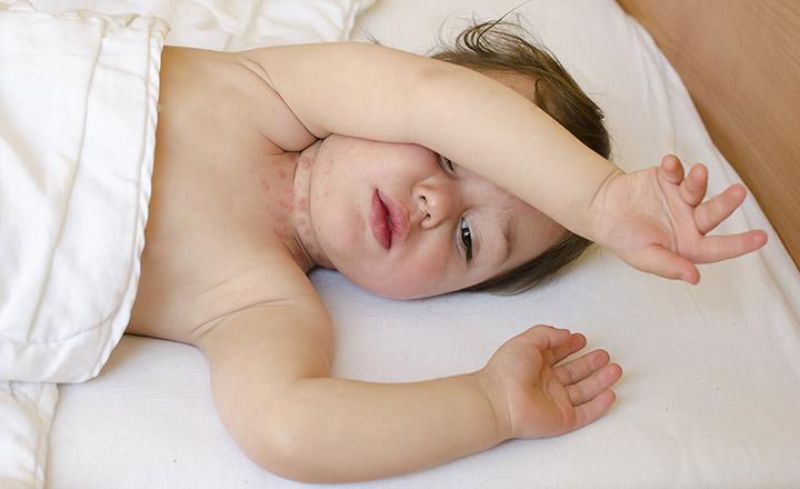 Trẻ sơ sinh bị nổi mẩn đỏ ở cổ là biểu hiện của bệnh Rôm sảy