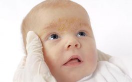Trẻ sơ sinh bị nổi mẩn đỏ ở đầu do bị dị ứng