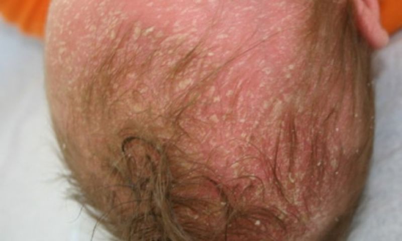 Vảy nến da dầu là một trong những nguyên nhân khiến trẻ bị nổi mẩn ngứa da đầu