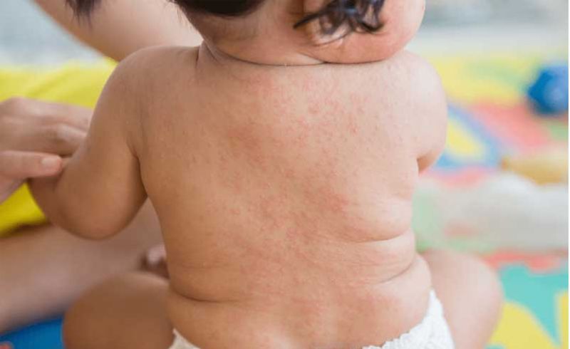 Sốt phát ban cũng có thể khiến trẻ bị nổi mẩn đỏ ở lưng