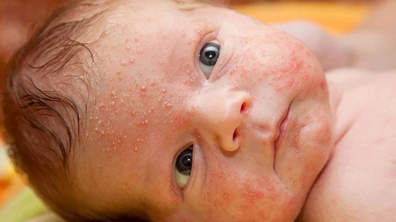 Viêm da tiết bã nhờn là nguyên nhân phổ biến khiến trẻ sơ sinh bị nổi mẩn đỏ ở mặt