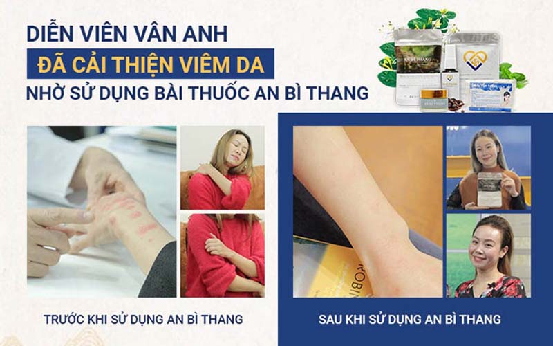 Hình ảnh TRƯỚC - SAU điều trị viêm da mãn tính của nữ diễn viên "Phía trước là bầu trời"