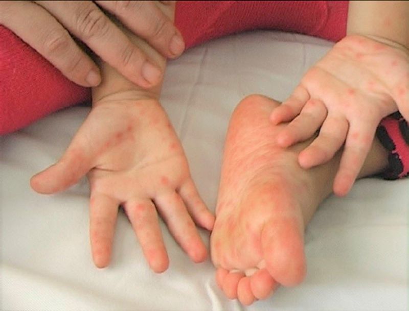 Sốt nổi mẩn đỏ ngứa ở trẻ em nghi ngờ bệnh chân tay miệng