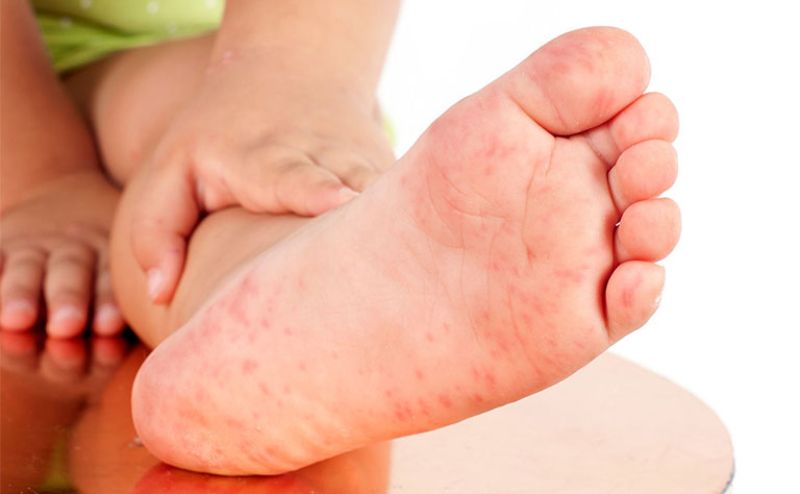 Một số nguyên nhân trẻ sơ sinh bị nổi mẩn đỏ ở chân cha mẹ cần chú ý