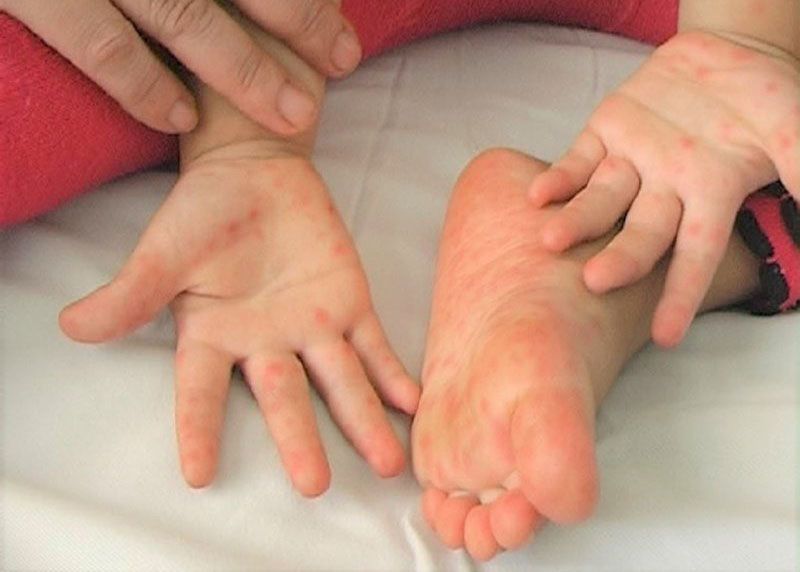 Trẻ bị nổi mẩn đỏ ở chân có thể do trẻ bị sốt phát ban