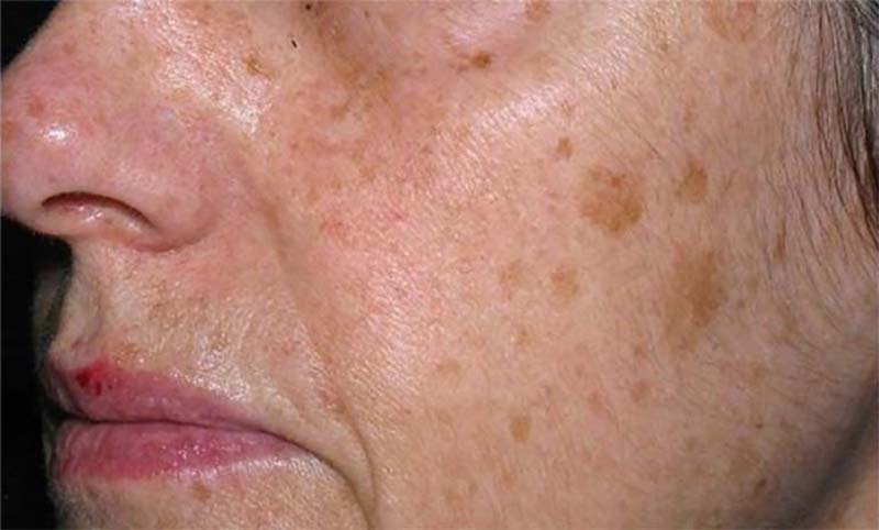Các đốm đồi mồi chủ yếu xuất hiện trên da mặt