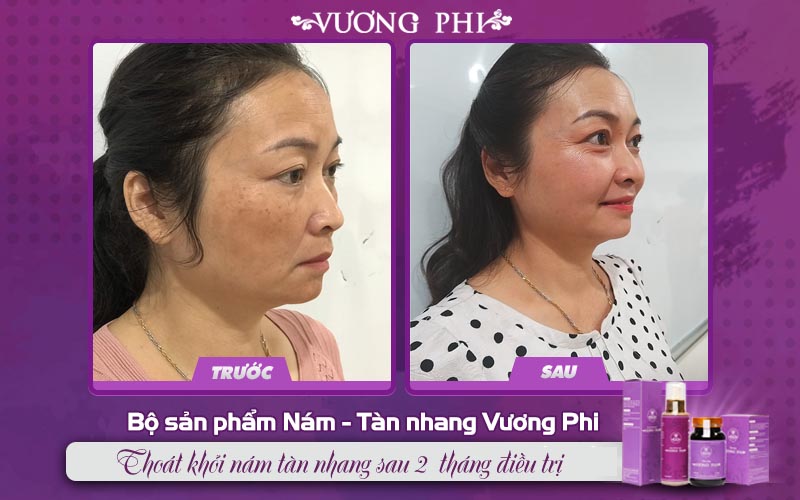 Thiếu tá Tạ Thị Vân (47 tuổi, điều trị nám lâu năm) nhận xét: “Mới dùng Vương Phi được gần 2 tháng thôi nhưng các vết nám lâu năm trên má, trán và cằm tôi đã giảm đi rõ rệt”.