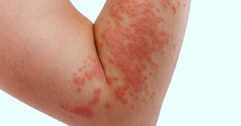 Nổi mẩn đỏ trên da là triệu chứng điển hình của mề đay