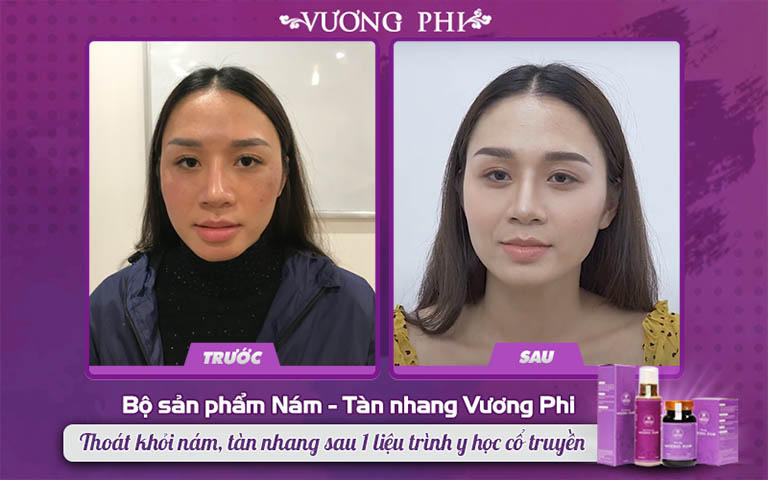 Chị Thu Hương đã điều trị nám sạm sau sinh thành công chỉ với 1 liệu trình y học cổ truyền