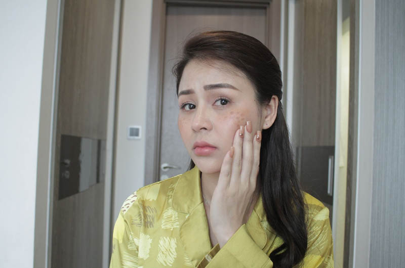 Tình trạng nám da, tàn nhang trước đây của diễn viên Thu Trang