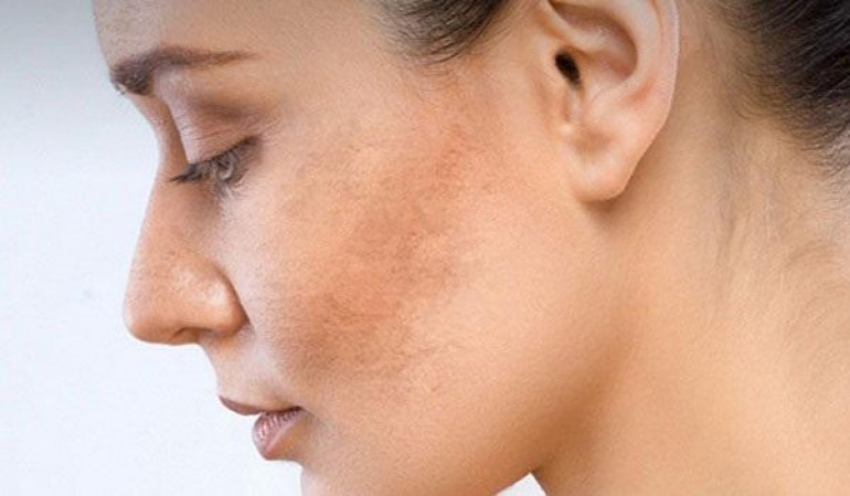 Có rất nhiều các cách chăm sóc da mặt bị sạm đen, các bạn có thể tham khảo để áp dụng với làn da của mình nhé