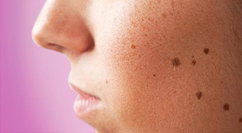 Da xuất hiện đốm nâu là hiện tượng phổ biến ở những chị em phơi nắng thường xuyên
