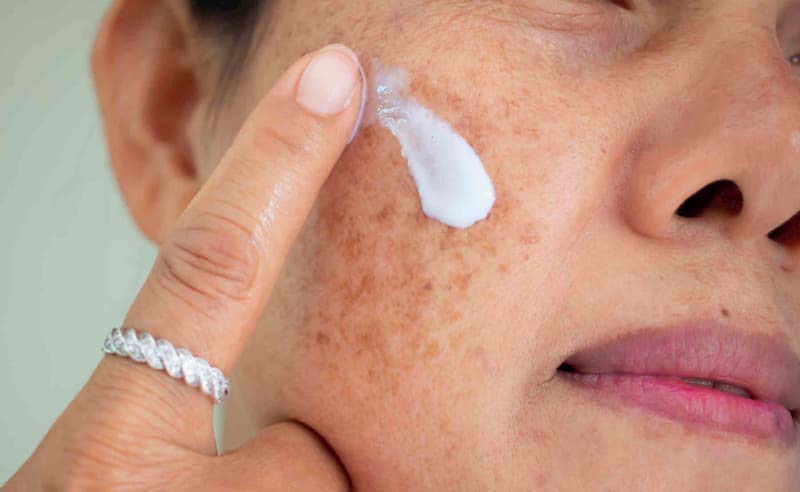Kem bôi tại chỗ trị nám mảng mang lại nhiều công dụng cho làn da
