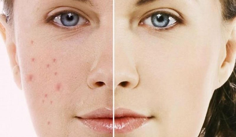 Da mặt trước và sau khi điều trị