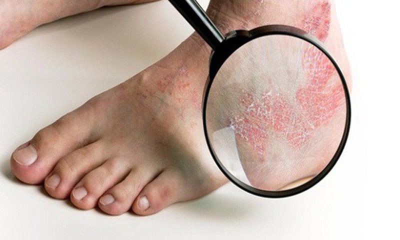 Vùng da bị tổn thương do hắc lào ở chân