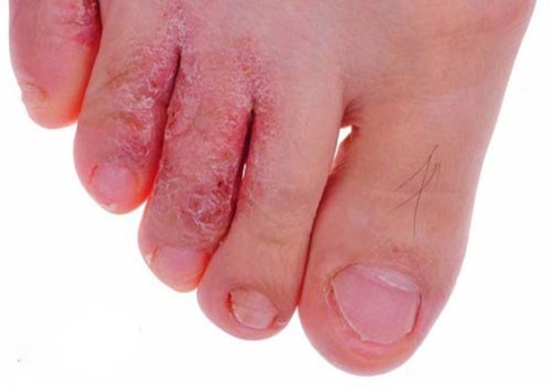 Hắc lào thường xuất hiện trên mu bàn chân hoặc kẽ ngón chân