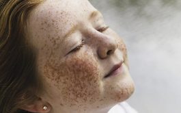Phụ huynh cần khuyến khích sự tự của trẻ em bị rối loạn sắc tố da