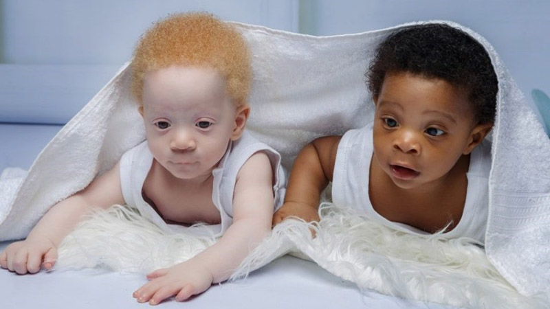Mặc dù trẻ em thuộc mọi chủng tộc đều bị ảnh hưởng như nhau, nhưng các đốm có xu hướng rõ ràng hơn ở những trẻ có làn da sẫm màu