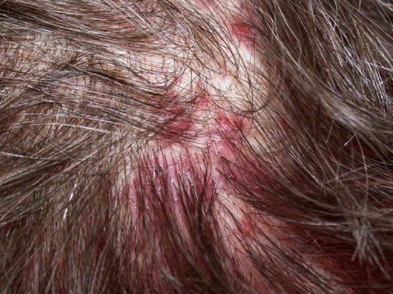 Bệnh viêm nang lông da đầu gây ngứa ngáy, rụng tóc