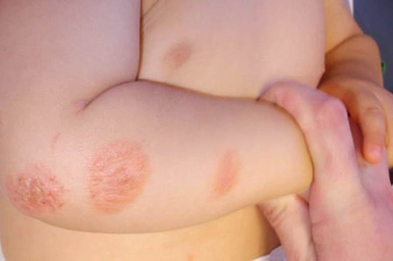 Bệnh đặc trung bởi những đốm đỏ hình tròn trên da của trẻ