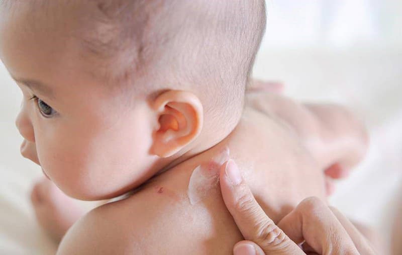 Hắc lào ở trẻ sơ sinh: Nguyên nhân và biện pháp điều trị an toàn