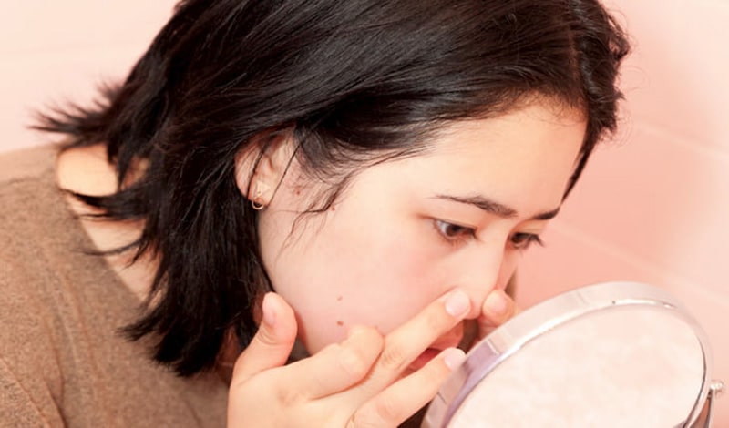 Cách Nặn Mụn Bọc An Toàn Không Nhiễm Trùng Không Để Lại Sẹo