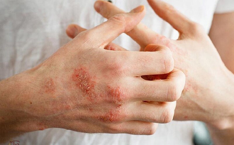 Tại vùng da bị tổn thương, tránh cào gãi vì sẽ khiến bệnh lây lan