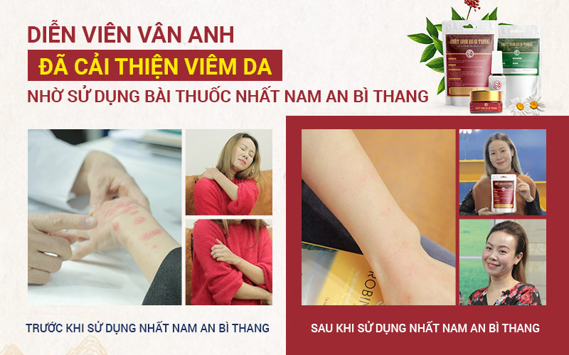 Diễn viên Vân Anh từng sử dụng Nhất Nam An Bì Thang loại bỏ viêm da tiếp xúc