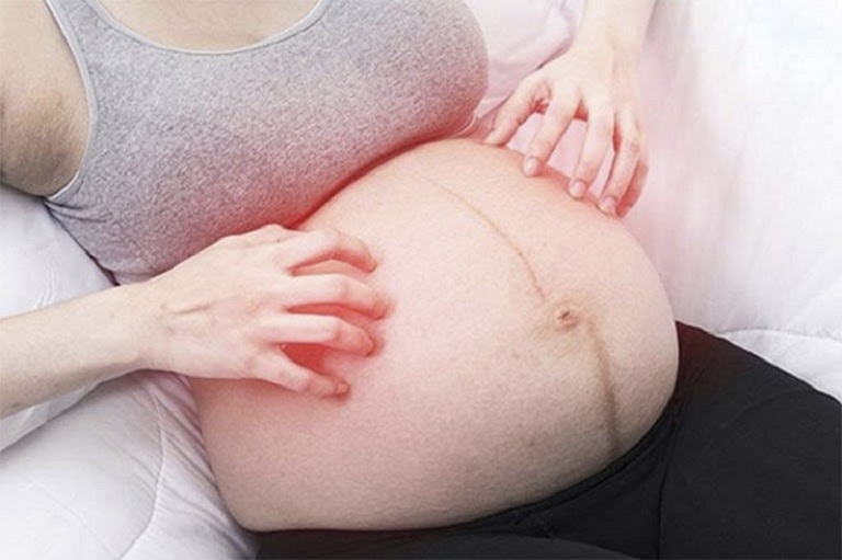Nổi mề đay khi mang thai, sau sinh rất dễ tái phát nhiều lần 