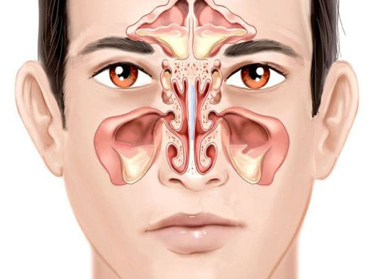 Viêm mũi dị ứng có thể gây biến chứng viêm xoang