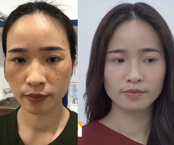 Hình ảnh trước và sau khi dùng giải pháp thảo dược của chị Thảo
