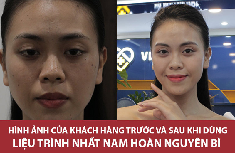 Làn da của chị Trang đã thực sự hồi sinh trở lại sau khi dùng liệu trình xử lý mụn Nhất Nam Hoàn Nguyên Bì