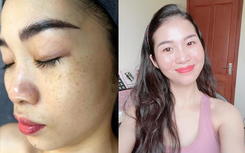 Làn da của chị Trang trước và sau khi sử dụng giải pháp thảo dược